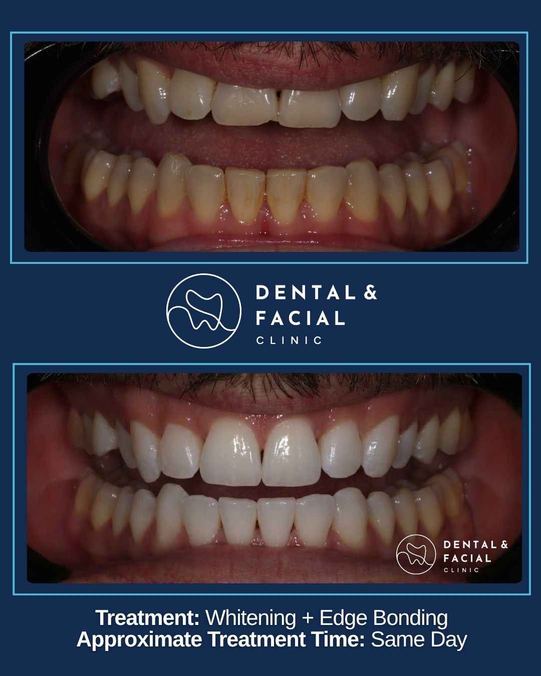 Teeth Whitening