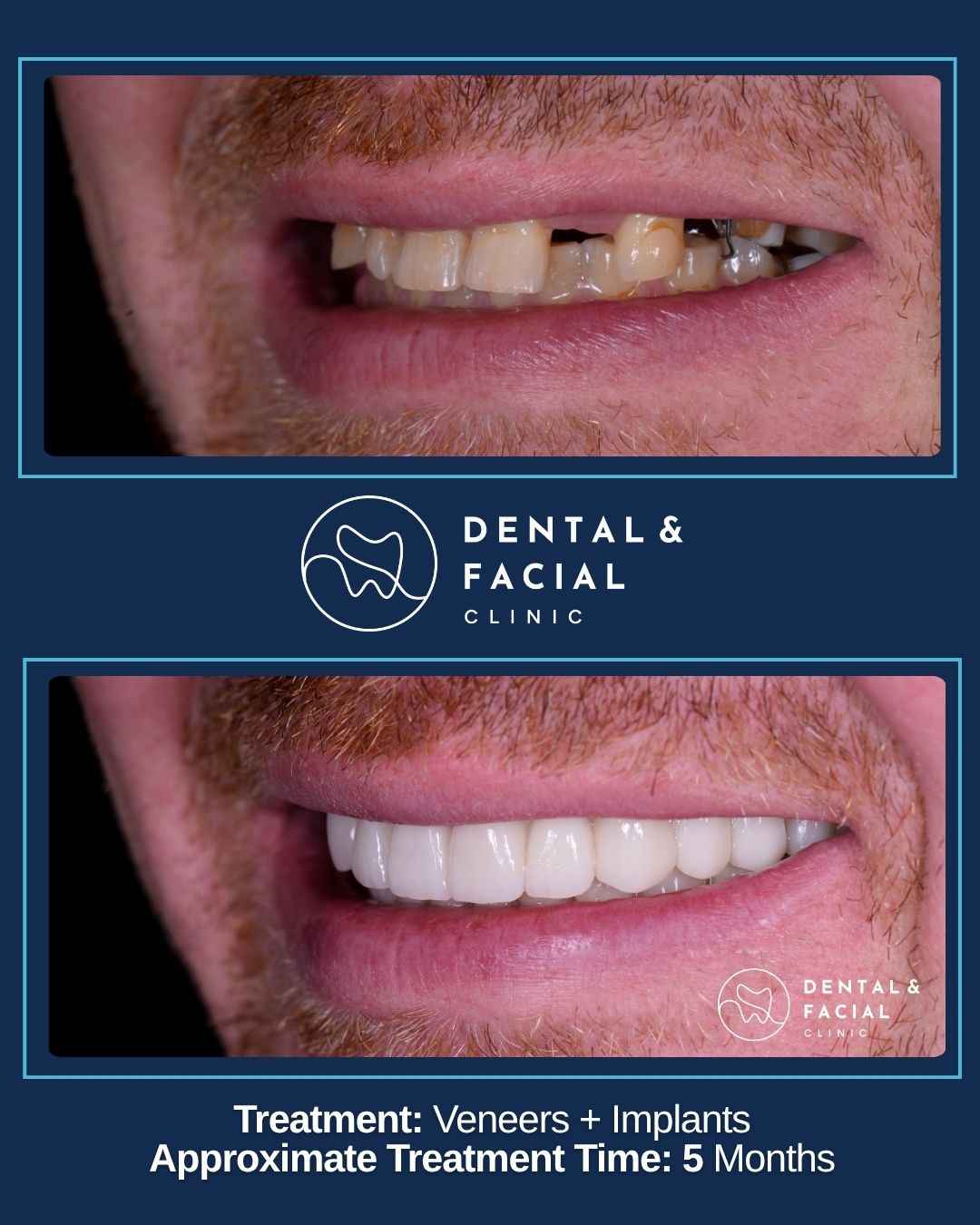 Veneers+ Impalants