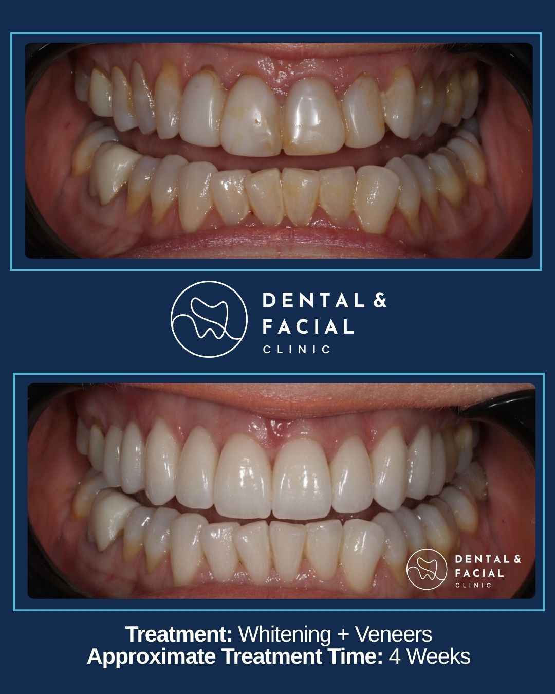 Whitening +Veneers