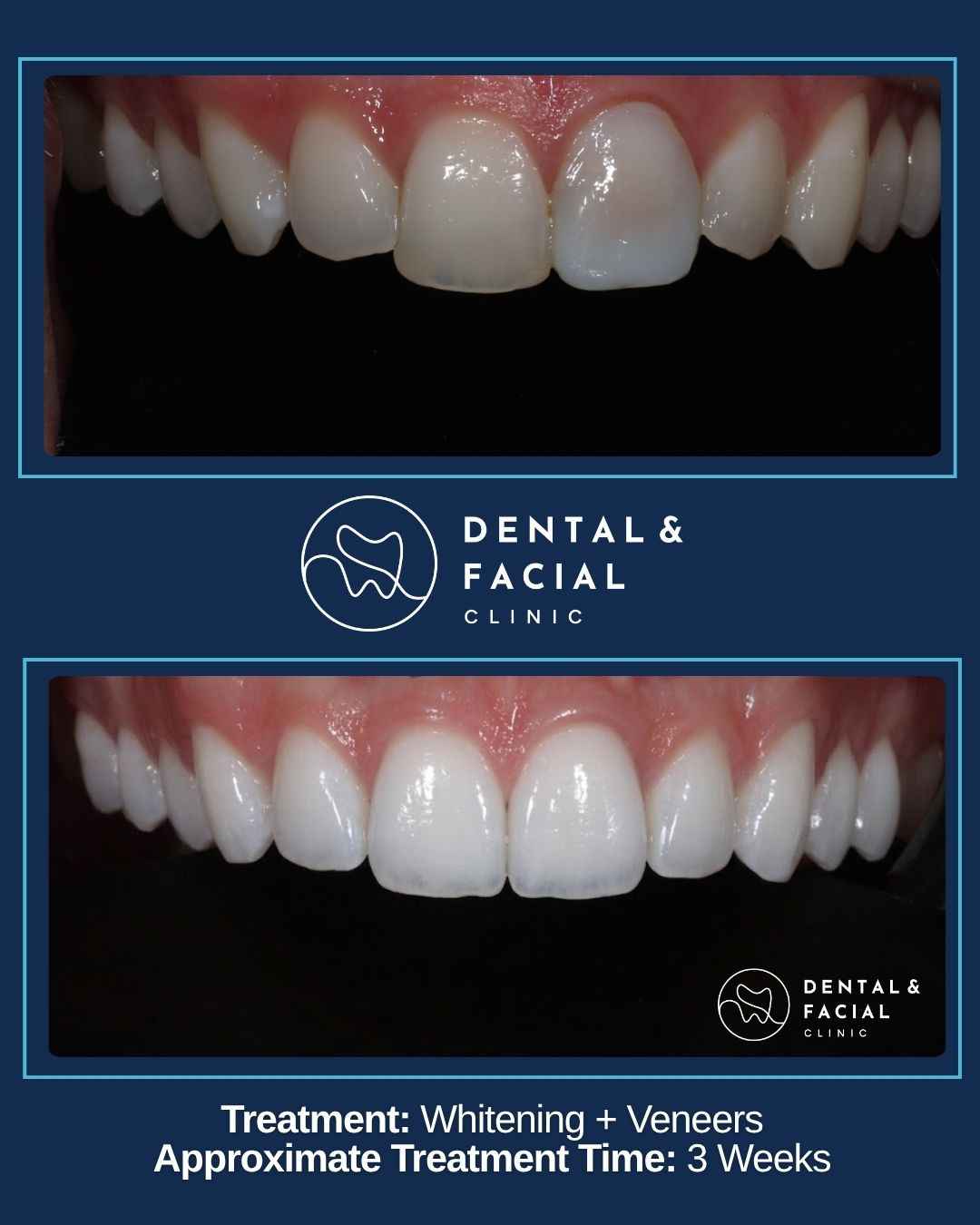 Whitening +Veneers