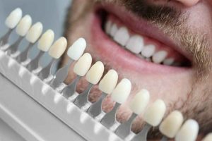 Composite Veneers