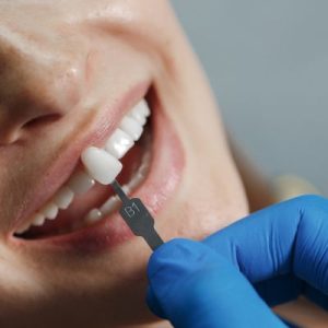 Composite Veneers