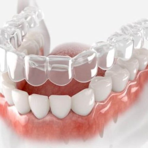 Clear Aligners