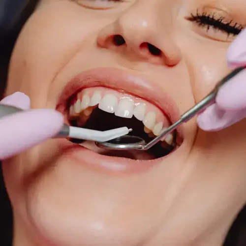 Signs You May Need Full Mouth Implants