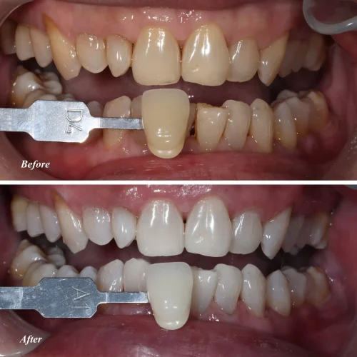 Teeth Whitening