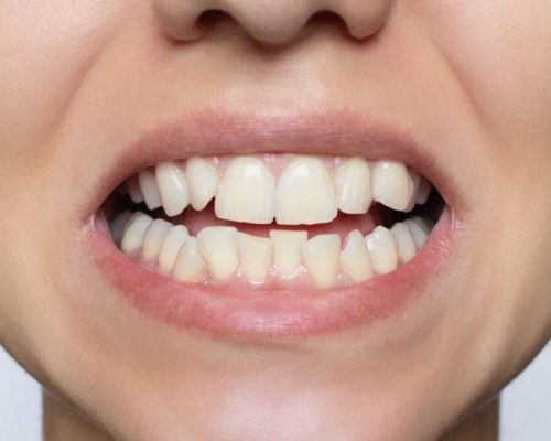 The Best Way to Fix Crooked Teeth