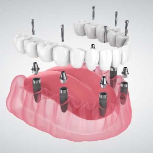 All on 6 Dental Implants