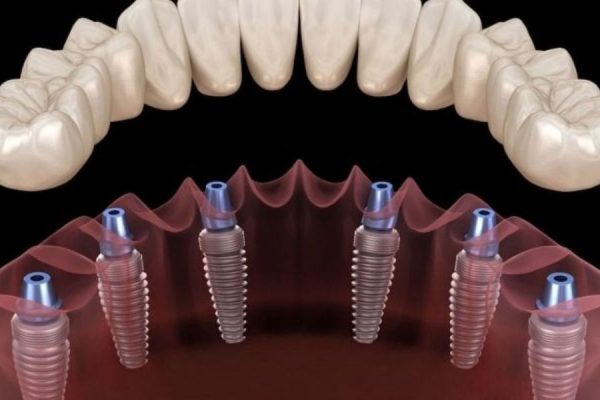 All on 6 Dental Implants