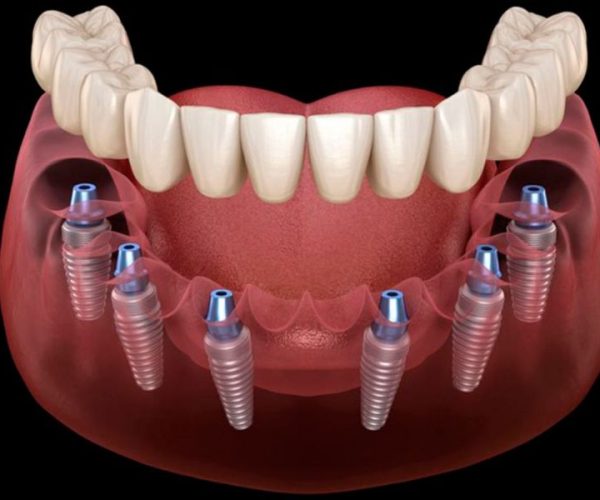 All on 6 Dental Implants
