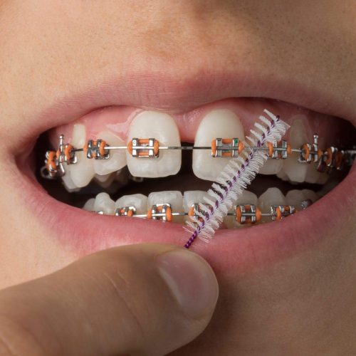 close up of cleaning dental braces