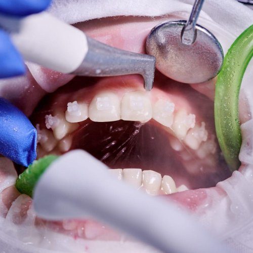 dental cleaning