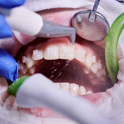 close up picture of a woman s mouth during dental procedure of cleaning teeth