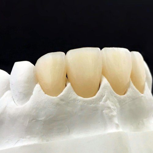dental zirconia crowns in the plaster model white dental veneer r8e7ogoa4hy48gasjf25bgea3z0p34l2w2o3ts8k94