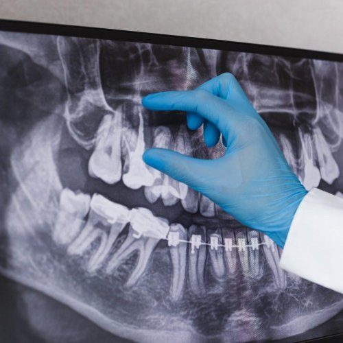 Root Canal Treatment