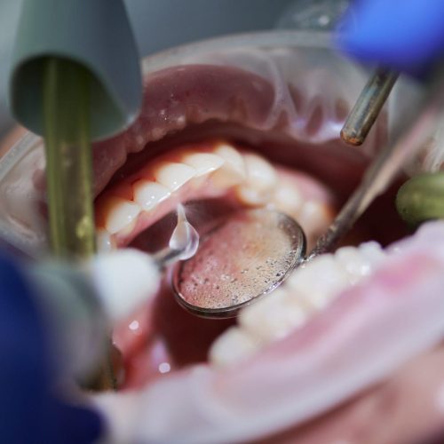 orthodontist doing professional teeth cleaning in dental clinic