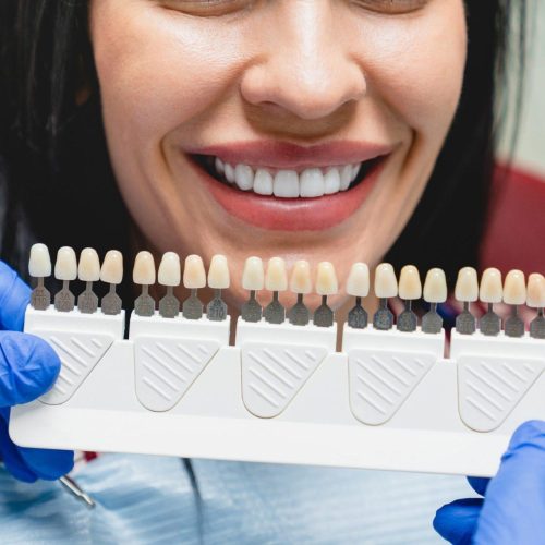 whitening concept dental care implants veneers woman with perfect smile choosing teeth tooth tone